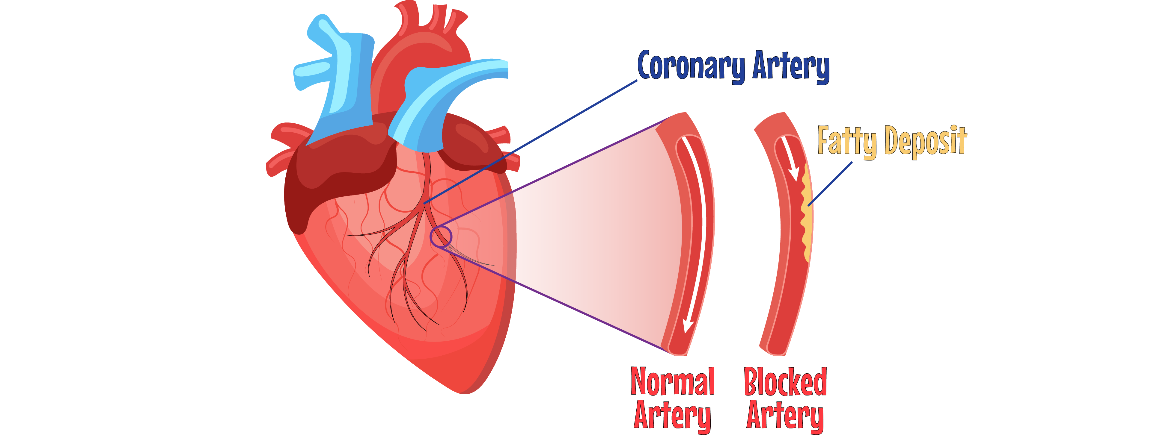 Coronary Artery