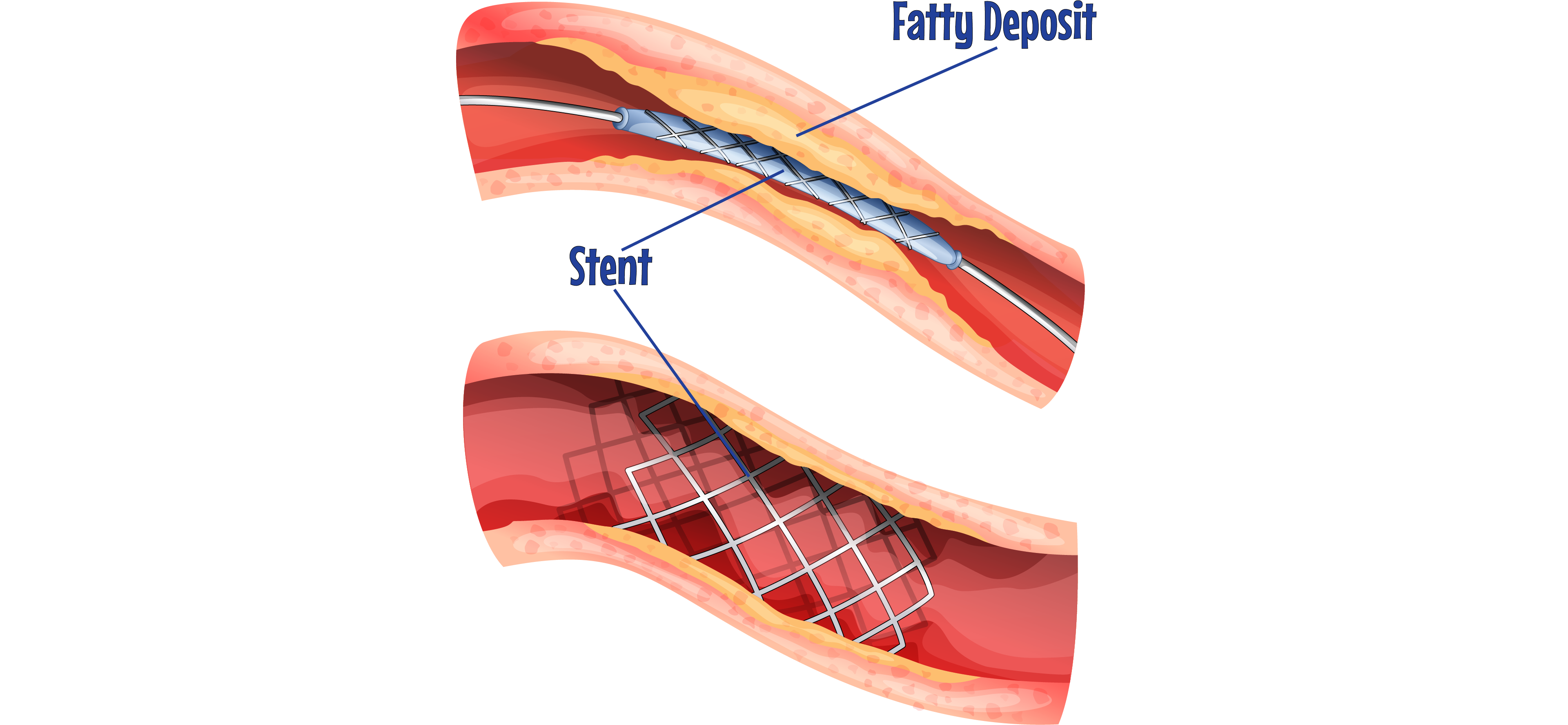 Stents