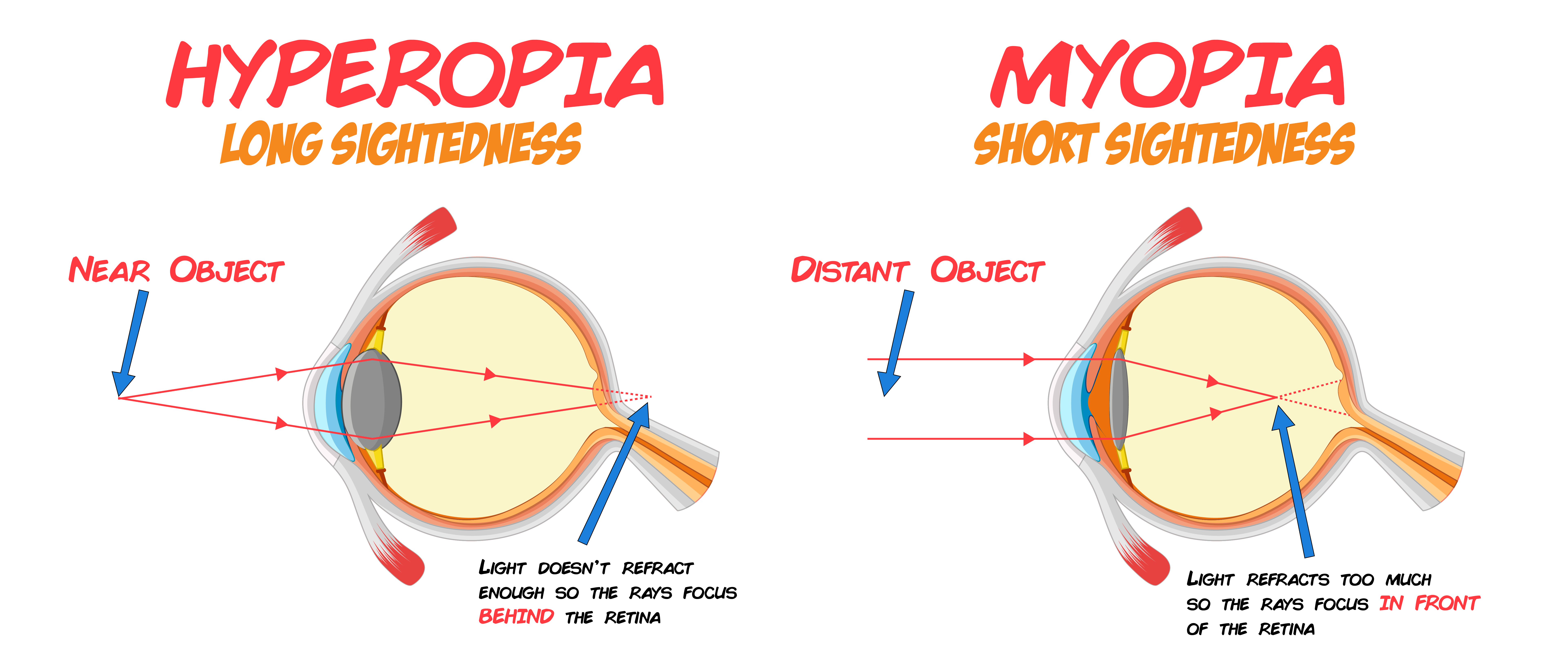 Hyperopia and Myopia